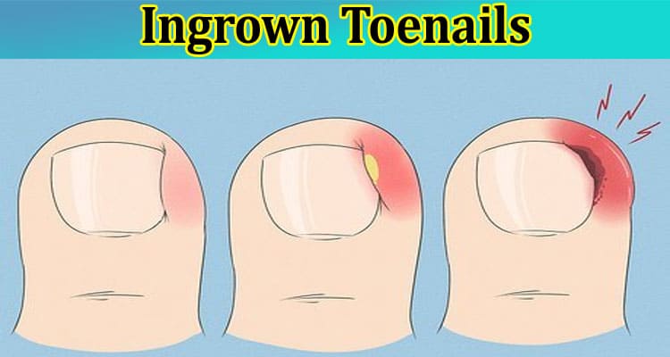 Complete Information About Get Rid of Your Ingrown Toenails Once and For All with Surgery