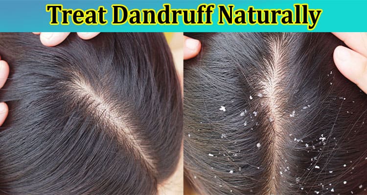 Complete Information About How to Treat Dandruff Naturally